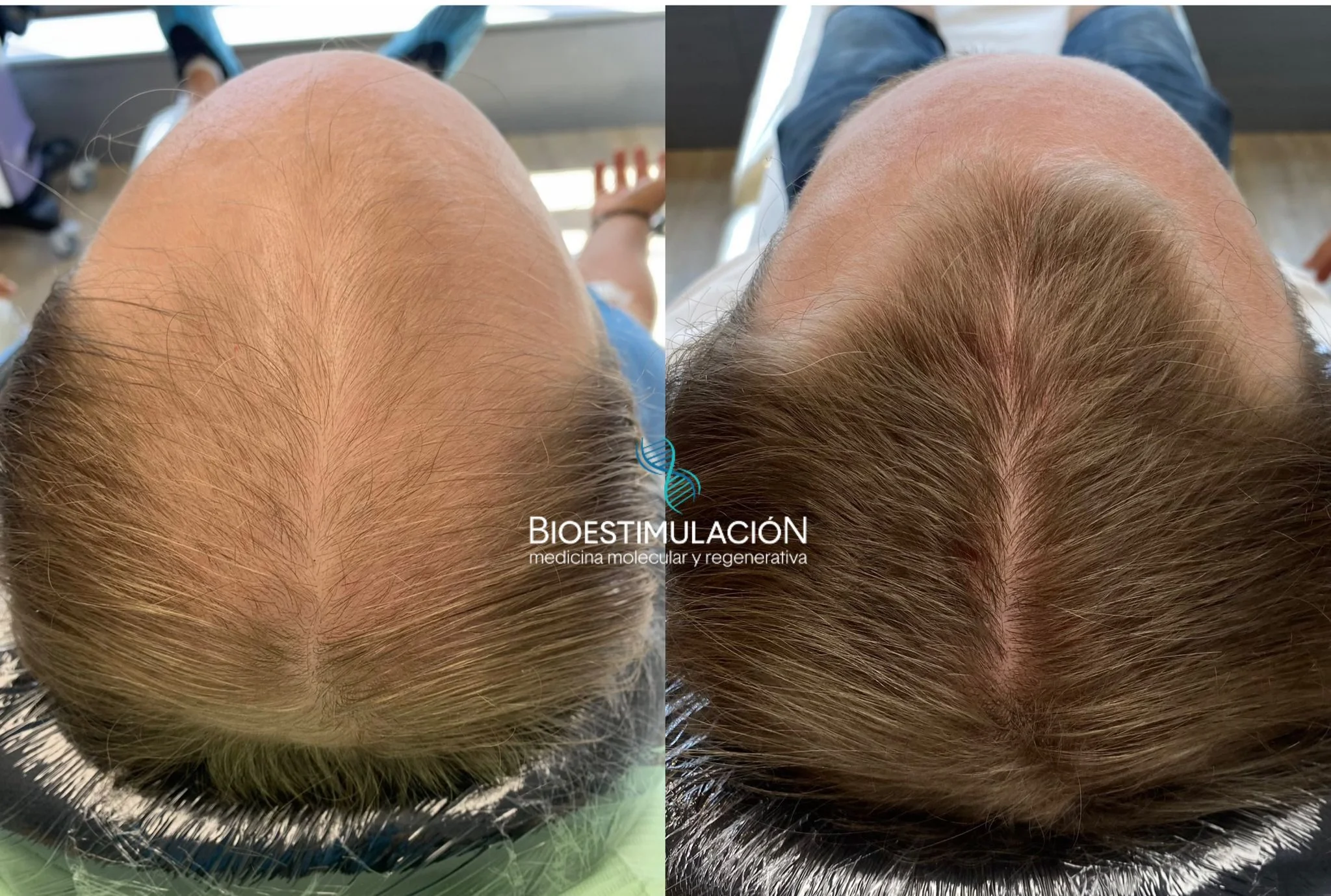 Tratamientos capilares en Montevideo – Bioestimulación